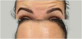 Image showing before and after pictures for botox treatment of a patient on forehead