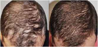 Image showing before and after pictures of PRP for Hair Restoration of a patient