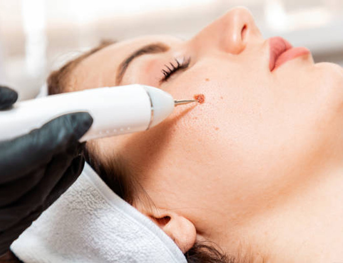 Stock image of a girl undergoing brith mark removal