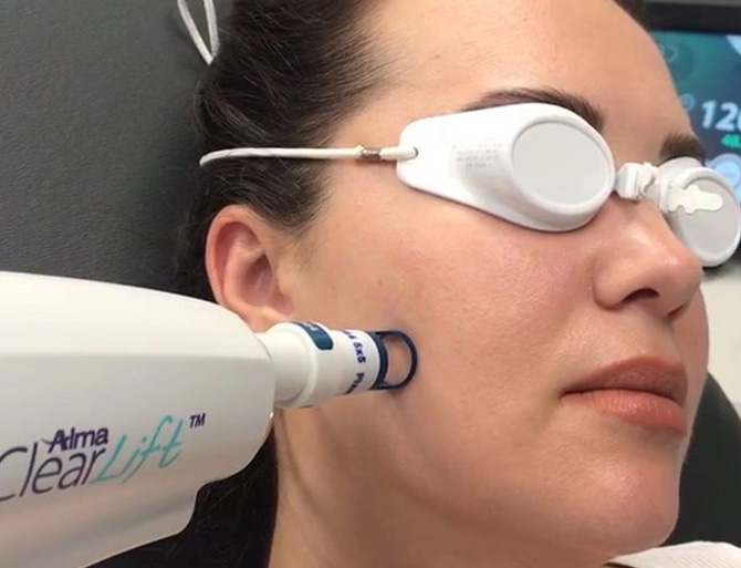 Stock image of a girl undergoing Clear lift treatment on her face