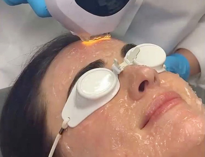 Stock image of face of a girl undergoing sun damage treatment