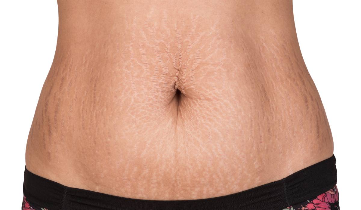 Featured image for Why Do Stretch Marks Appear on Some Areas of the Body and Not Others