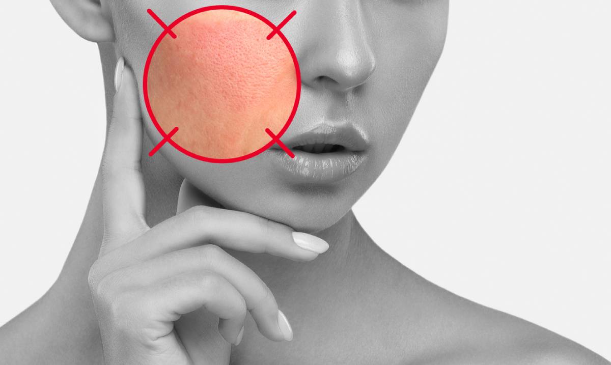 featured image for the most common rosacea triggers article