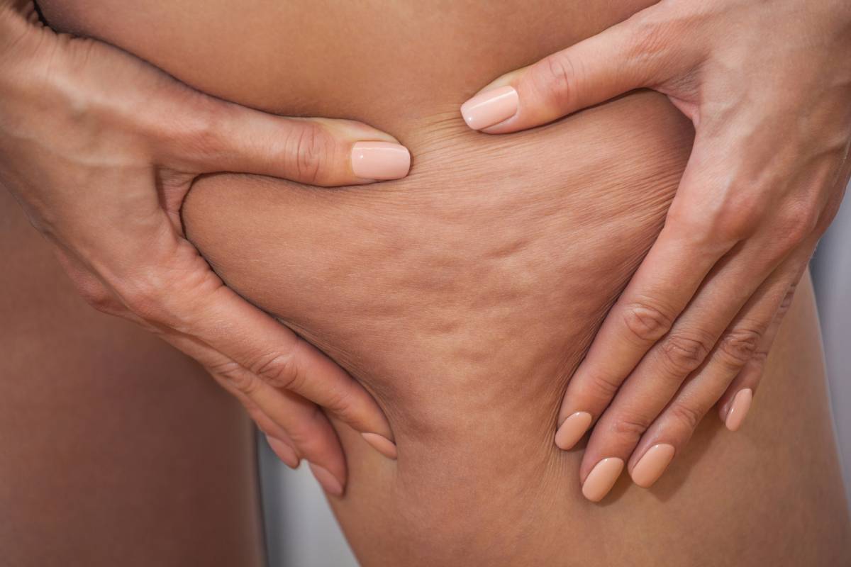 Girl shown holding skin of the legs to reveal cellulite.